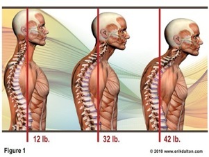 osteoarthritis neck